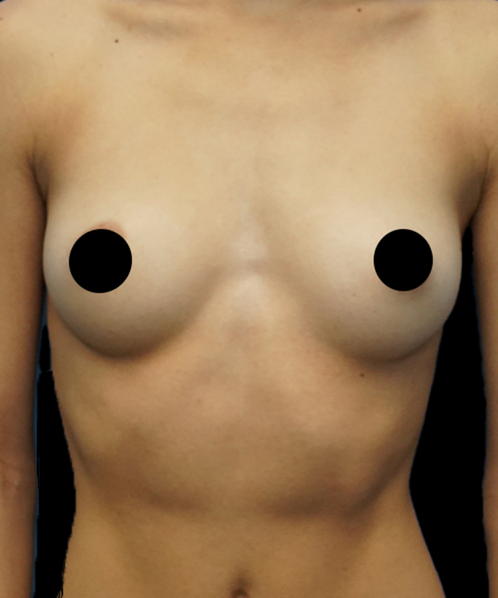 Breast augmentation patient