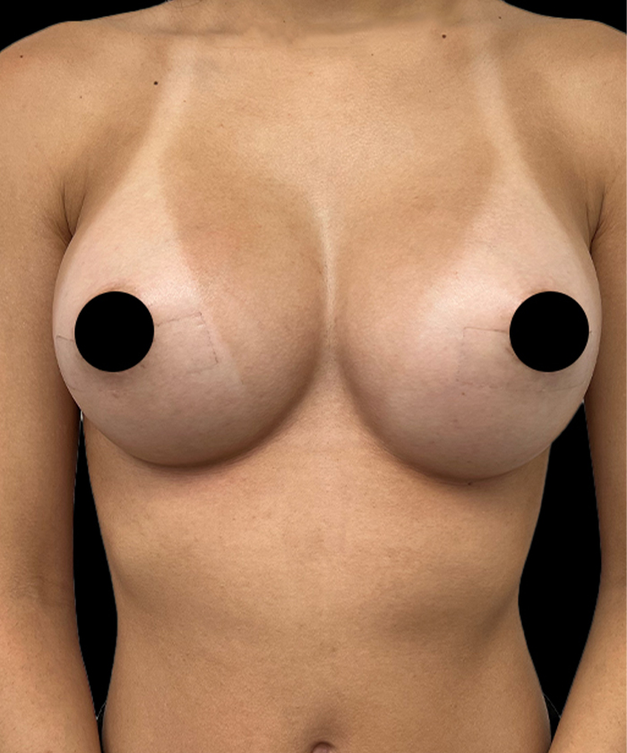 The same breast augmentation patient