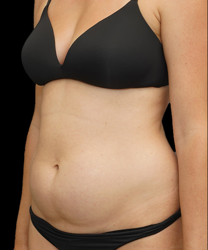 Liposuction