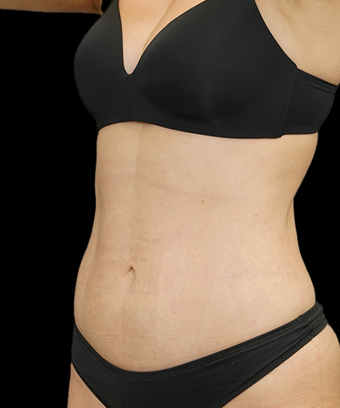 Liposuction