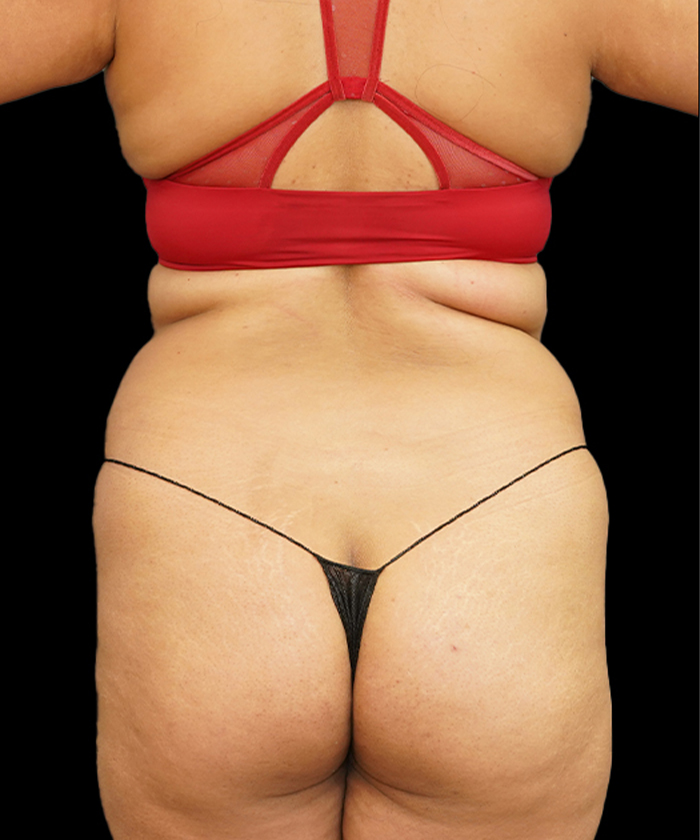 Liposuction