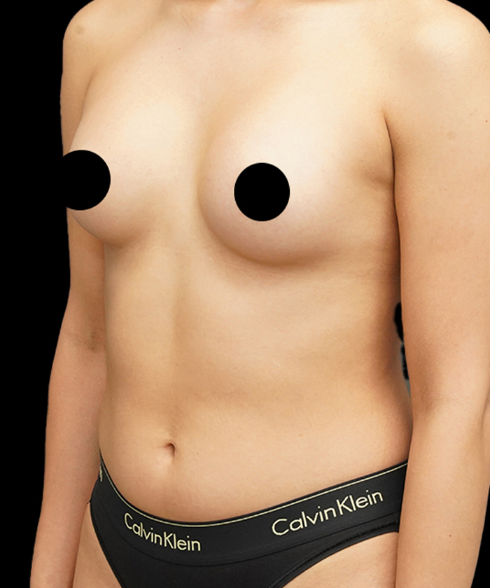Liposuction