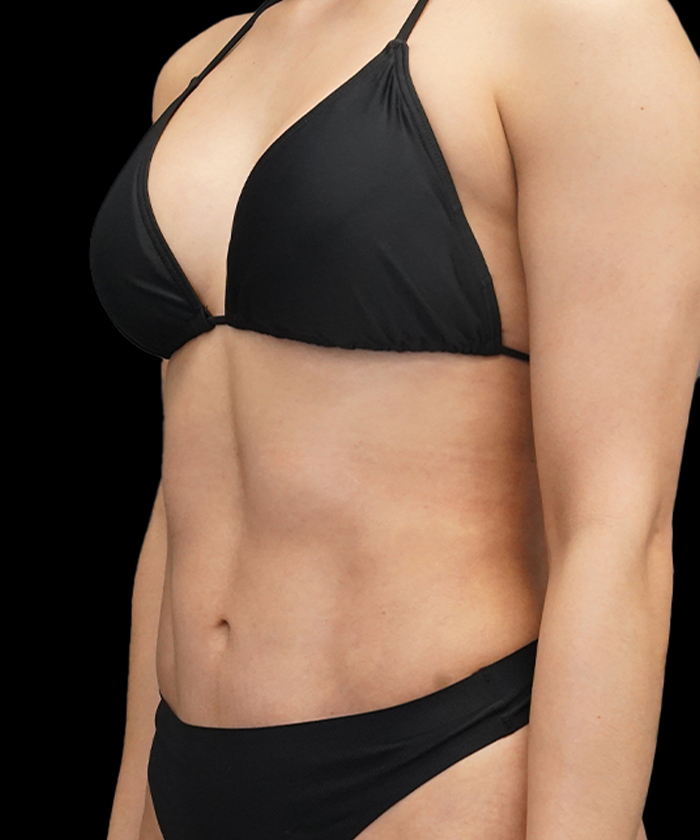 Liposuction