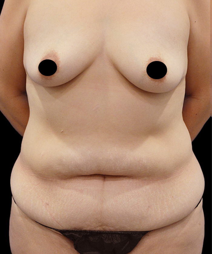 Tummy tuck patient