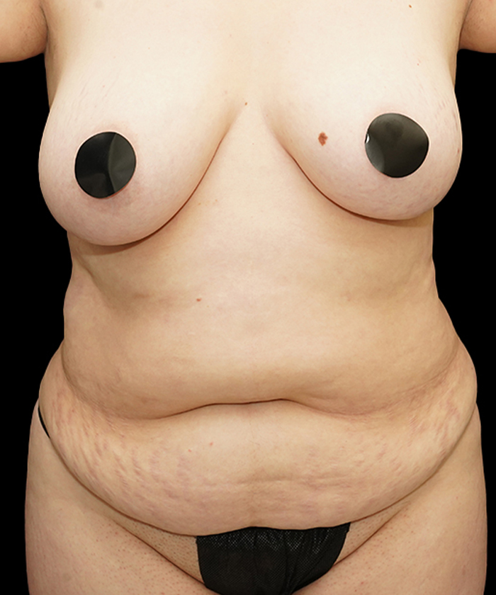 Tummy tuck patient