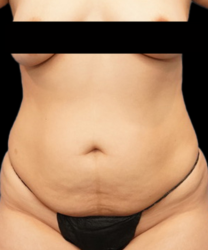 Tummy tuck patient
