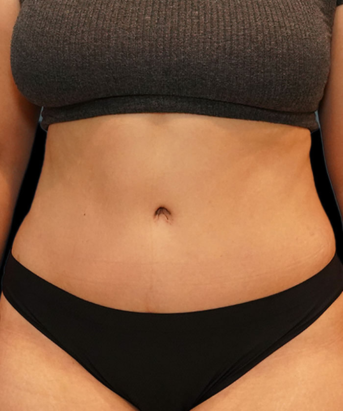 Tummy tuck patient