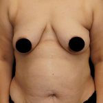 Tummy Tuck Before & After Patient #372