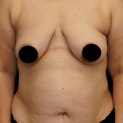 Tummy Tuck Before & After Patient #372