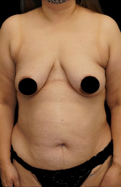 Tummy Tuck Before & After Patient #372