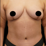 Tummy Tuck Before & After Patient #372