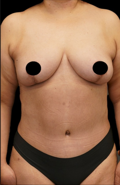Tummy Tuck Before & After Patient #372