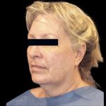 Facelift Before & After Patient #607