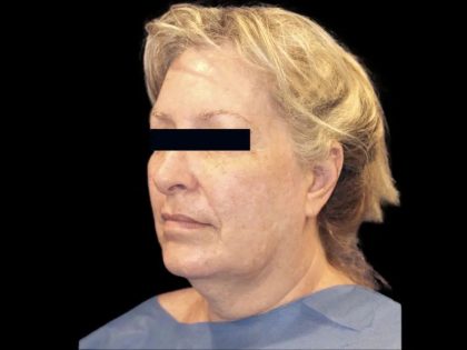 Facelift Before & After Patient #607