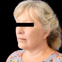 Facelift Before & After Patient #607