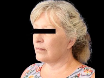 Facelift Before & After Patient #607