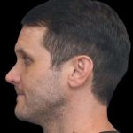 Rhinoplasty Before & After Patient #260