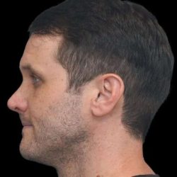Rhinoplasty Before & After Patient #260
