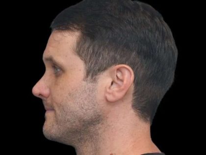 Rhinoplasty Before & After Patient #260