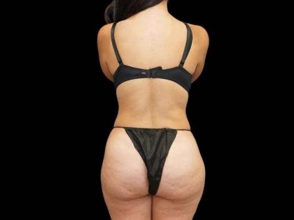 Brazilian Butt Lift Before & After Patient #311