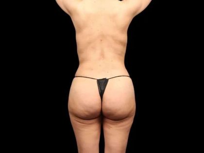 Brazilian Butt Lift Before & After Patient #318