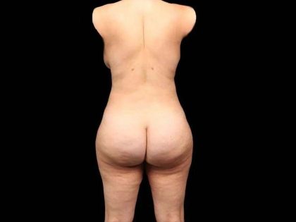 Brazilian Butt Lift Before & After Patient #330