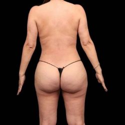 Brazilian Butt Lift Before & After Patient #335