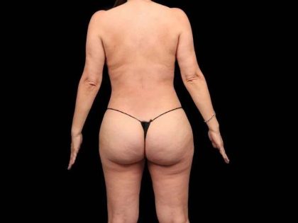 Brazilian Butt Lift Before & After Patient #335