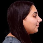 Rhinoplasty Before & After Patient #253