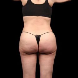 Brazilian Butt Lift Before & After Patient #350
