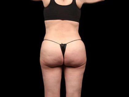 Brazilian Butt Lift Before & After Patient #350