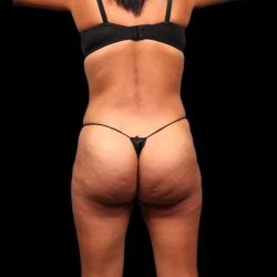 Brazilian Butt Lift Before & After Patient #355