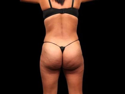 Brazilian Butt Lift Before & After Patient #355