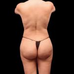 Brazilian Butt Lift Before & After Patient #362