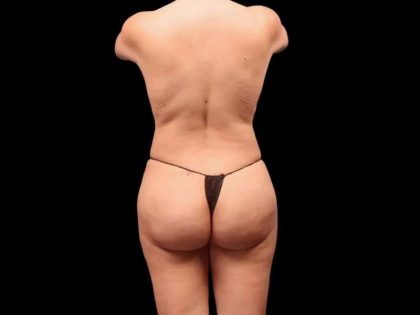 Brazilian Butt Lift Before & After Patient #362