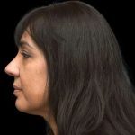Rhinoplasty Before & After Patient #267