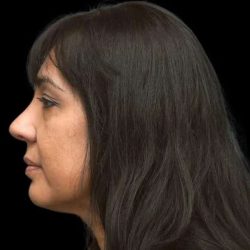 Rhinoplasty Before & After Patient #267