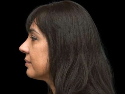 Rhinoplasty Before & After Patient #267