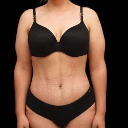 Tummy Tuck Before & After Patient #379