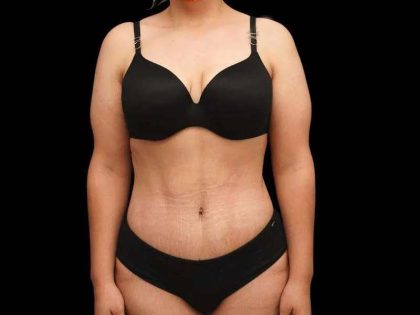 Tummy Tuck Before & After Patient #379