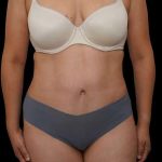 Tummy Tuck Before & After Patient #386