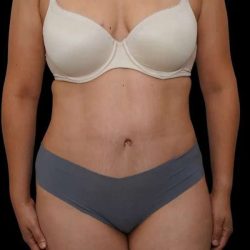 Tummy Tuck Before & After Patient #386