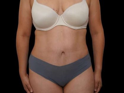 Tummy Tuck Before & After Patient #386