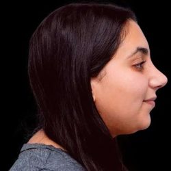 Rhinoplasty Before & After Patient #253