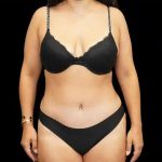 Tummy Tuck Before & After Patient #407