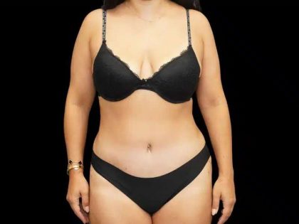 Tummy Tuck Before & After Patient #407