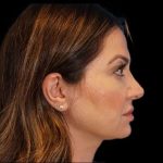 Rhinoplasty Before & After Patient #274