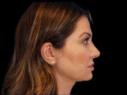 Rhinoplasty Before & After Patient #274