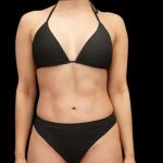 Liposuction Before & After Patient #429