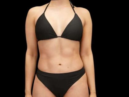 Liposuction Before & After Patient #429